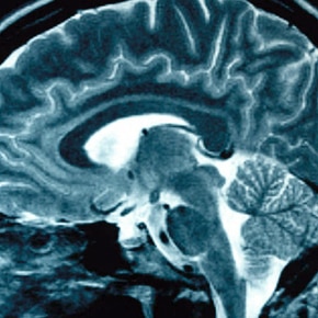 Alzheimer: conheça a doença e saiba a importância do diagnóstico precoce  