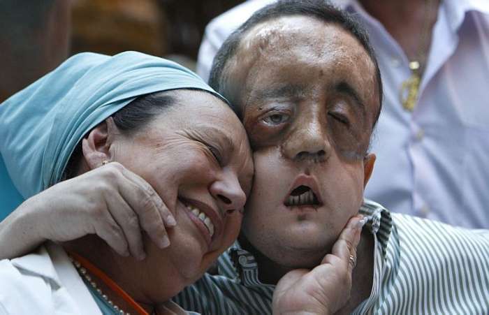 Rafael, paciente a receber transplante parcial da estrutura facial, teve alta médica na Espanha