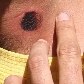 Homem mostra o ferimento causado por munições de borracha Homem mostra o ferimento causado por munições de borracha