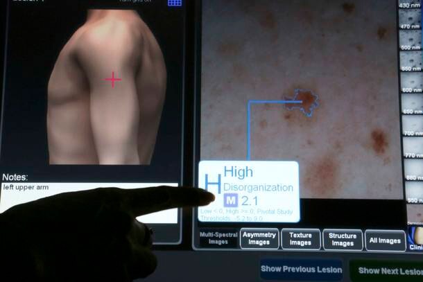 Cientistas identificam proteína responsável por alastramento do melanoma