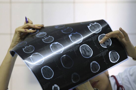 Pernambuco é o Estado com maior número de registros de microcefalia