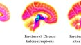 Cientistas descobrem sinais de Parkinson muitos anos antes dos sintomas