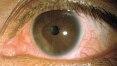 Pesquisa revela que zika pode causar problemas oculares em adultos