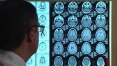 Cientistas desenvolvem método para diferenciar Alzheimer de outra demência