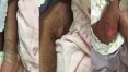 Ceará relata queimaduras em bebês vítimas de chikungunya