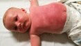 Bebê é internado após uso de protetor solar; veja como proteger as crianças do sol no verão