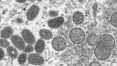 Varíola dos macacos: disparam encomendas a laboratório dinamarquês, único com vacina contra a doença