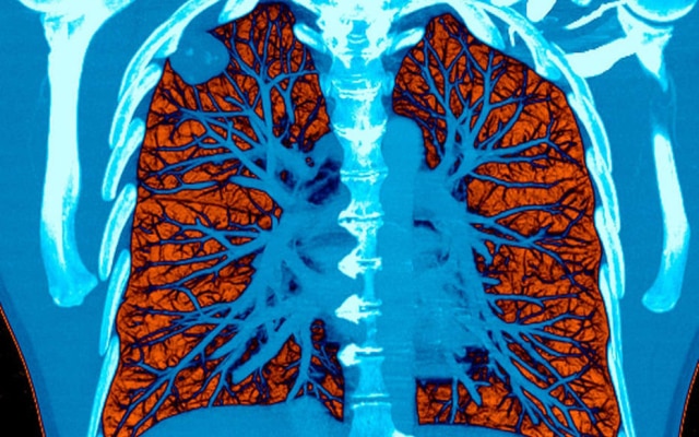 IA pode ler tomografias e ajudar a detectar casos