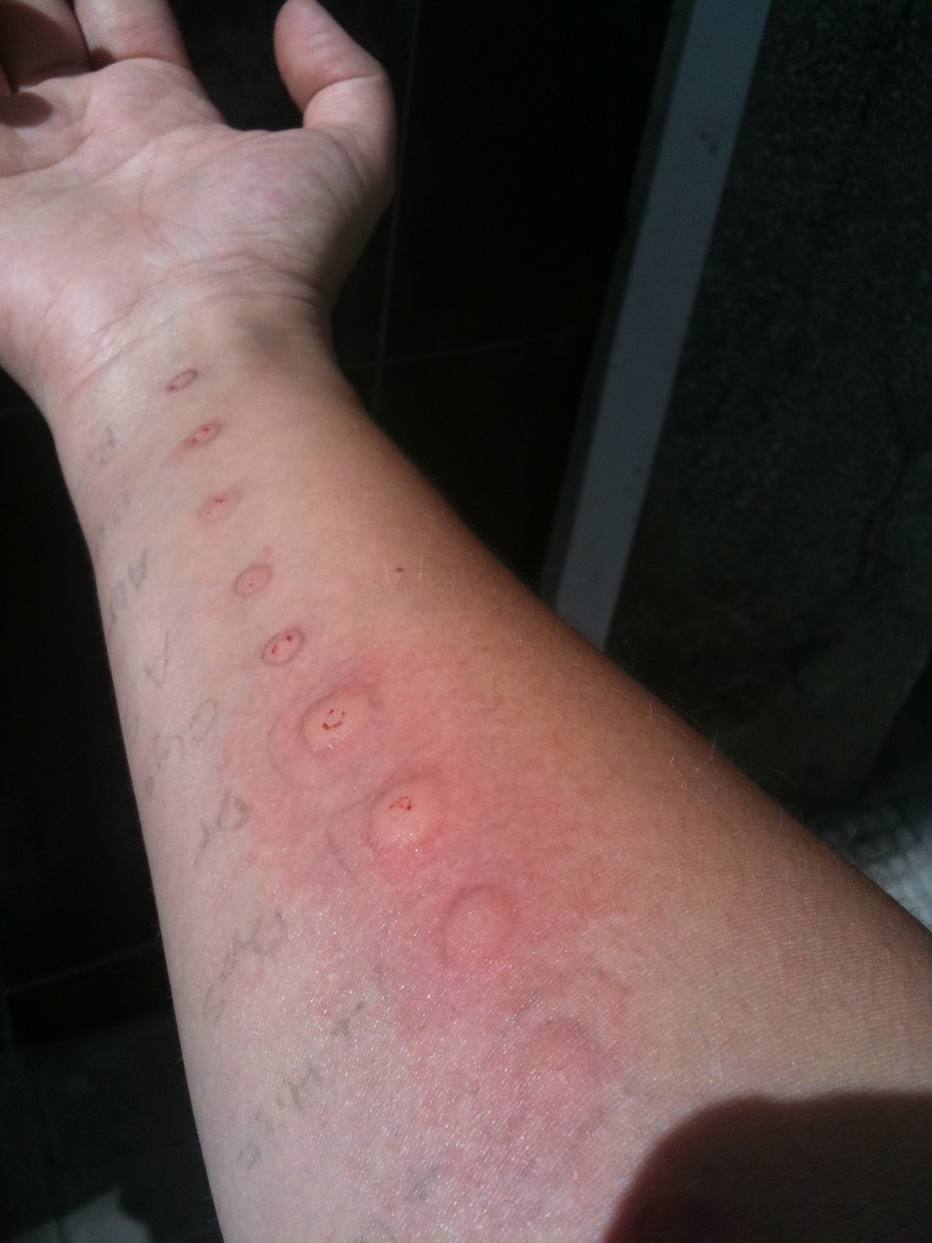 alergia ao latex alimentos alergia ao latex alimentos