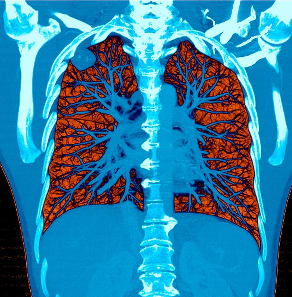 Um sistema de inteligência artificial leu com precisão tomografias computadorizadas dos pulmões em 94% dos casos em um novo estudo.