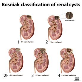 Voce Sabe A Diferenca Entre Cisto E Calculo Renal Emais Estadao