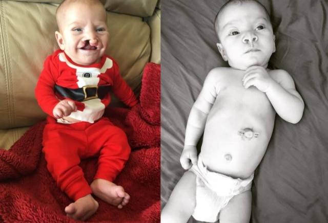 Reprodução/ Instagram Brody, de três meses, deve passar por mais uma cirurgia entre os nove e 12 meses
