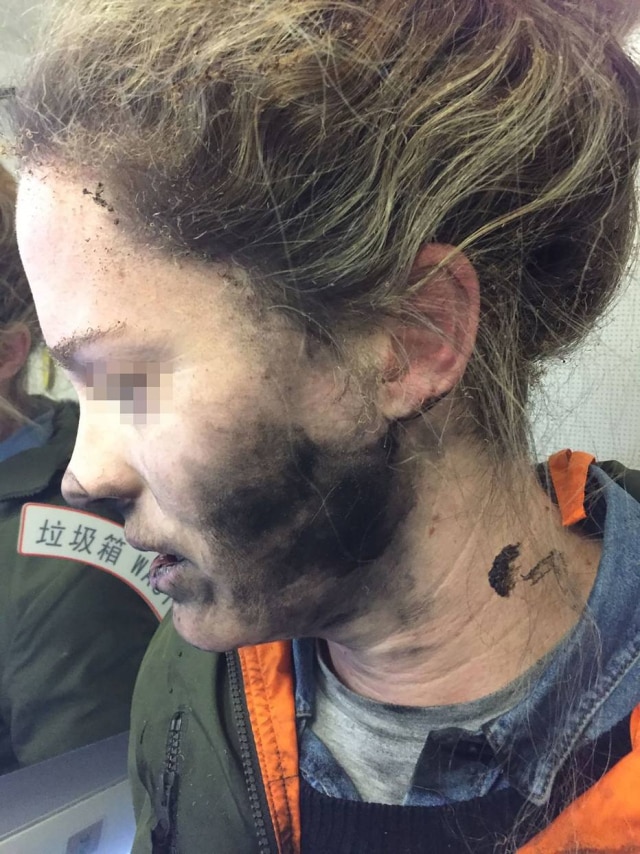AFP PHOTO / AUSTRALIA TRANSPORT SAFETY BUREAU Além do rosto, a passageira teve ferimentos nas mãos ao tentar tirar os fones de ouvido.