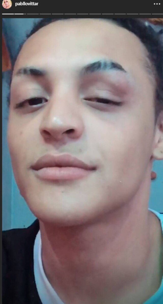 Instagram / @pabllovittar A cantora Pabllo Vittar após machucar o olho com seu joelho.