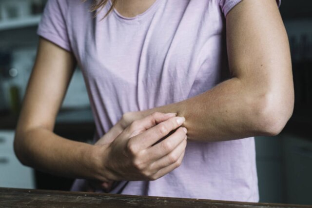 Freepik A dermatite atópica é caracterizada pelo surgimento de inflamações na pele que geram uma coceira intensa