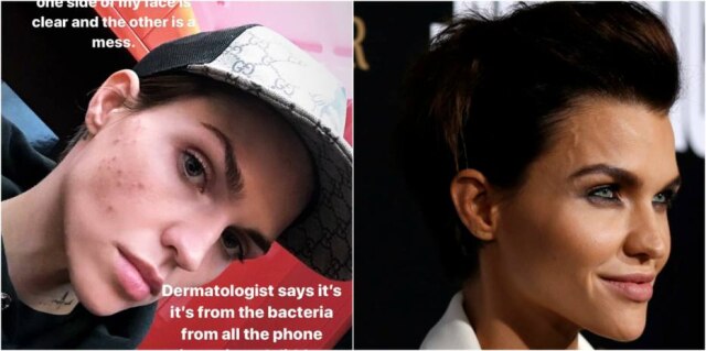 Instagram/@rubyrose | Mario Anzuoni/Reuters A atriz australiana Ruby Rose compartilhou no Instagram como ficou o seu rosto após uma reação alérgica em decorrência do uso excessivo de telefone celular