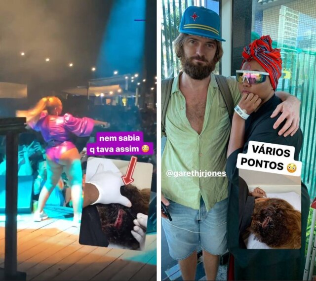 Instagram / @gabyamarantos Stories postados por Gaby Amarantos após ter recebido pontos na cabeça por conta de queda no palco durante show.