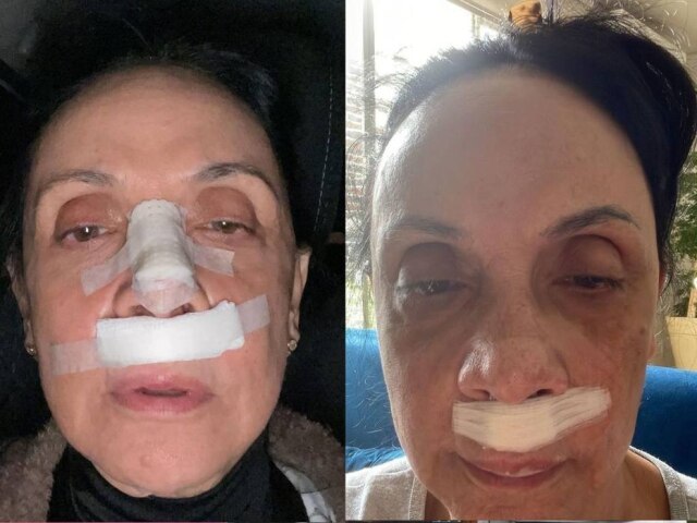 Instagram/@cininha_de_paula Cininha de Paula contou que sofreu uma queda durante o trabalho.