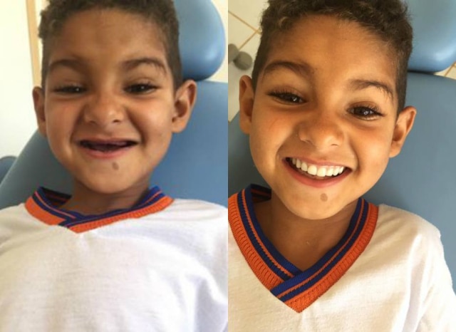 Reprodução/Facebook O antes e depois de Ryan, que ganhou dentes