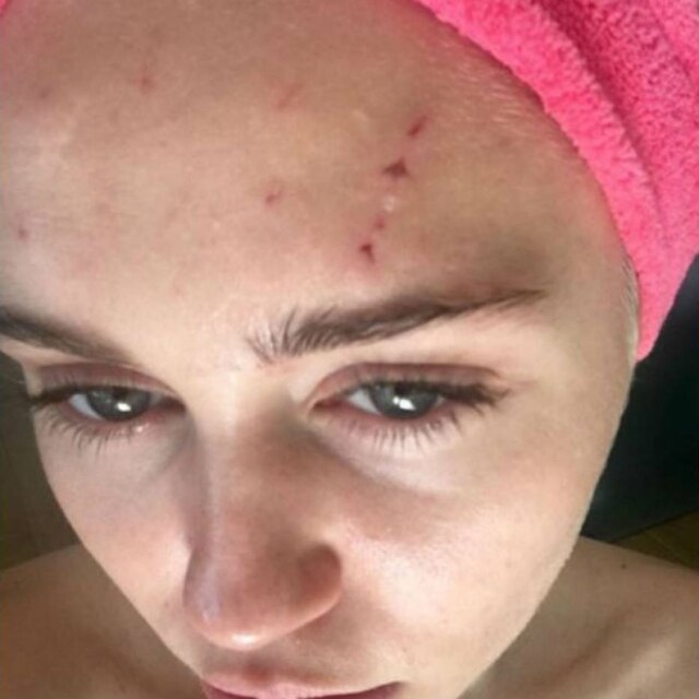 Instagram|Reprodução Miley exibe lacerações
