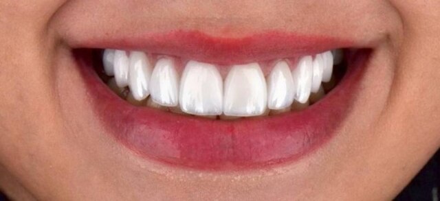 Instagram/@dr.pauloantonioli O tratamento deve ser indicado somente após a constatação de que os dentes, gengivas e outros componentes da cavidade bucal estão saudáveis.