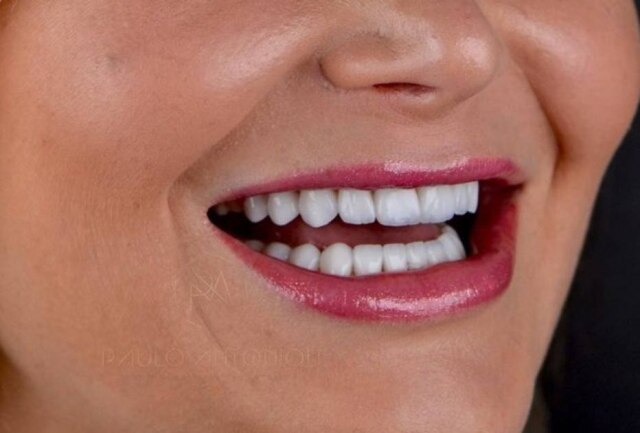 Instagram/@dr.pauloantonioli Tratamento está sendo muito procurado nos consultórios dentários do País.