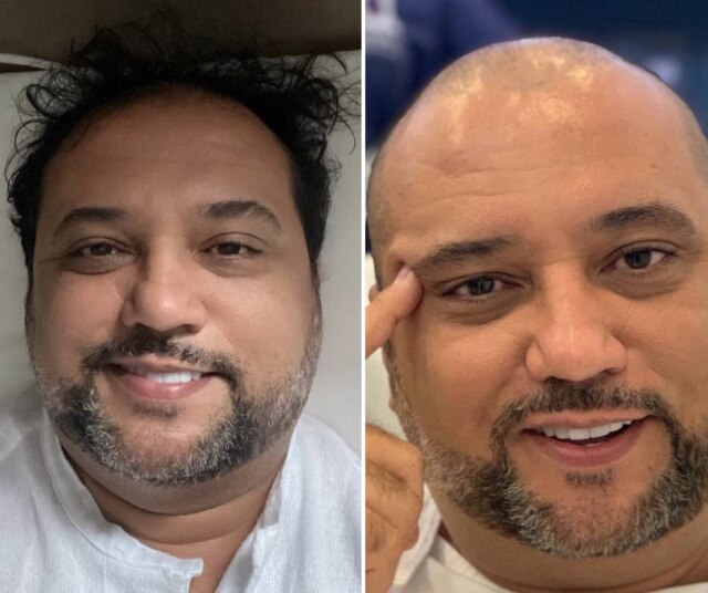 Instagram/@geraldobalanca O apresentador Geraldo Luís, que compartilhou resultado de transplante capilar nas redes sociais