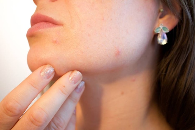 Kjerstin_Michaela/Pixabay Acnes são o principal motivo de visita ao dermatologista.