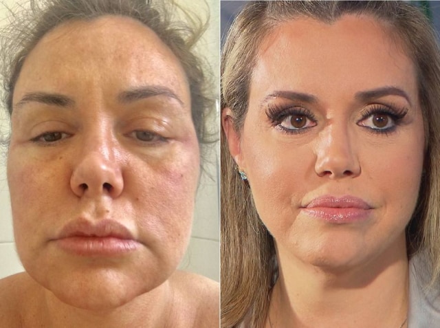 Record TV/Divulgação Renata Banhara fala sobre suas paralisias faciais ao 'Câmera Record'