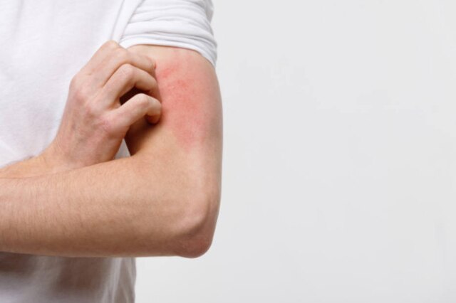 Freepik / @dimaberlin A psoríase e a dermatite atópica estão ligadas à necessidade de manter a pele hidratada