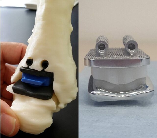 Instituto Ortopédico Rizzoli de Bolonha Primeira prótese de tornozelo feita em uma impressora 3D foi produzida na Itália