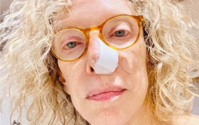 Instagram/ @gabi_mariliagabriela Marília Gabriela fez uma cirurgia de retirada de um câncer de pele na narina esquerda
