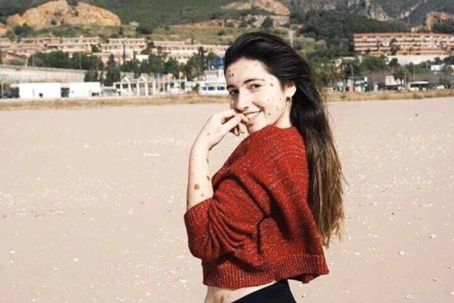 www.instagram.com/albaparejo_ A jovem Alba Parejo possui melanose congênita, que faz com que seu corpo seja coberto por manchas