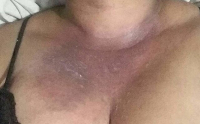 Kelly Lima Kelly Lima afirma que lesões no busto, mostradas na imagem, são as mais leves que ela já teve até hoje.