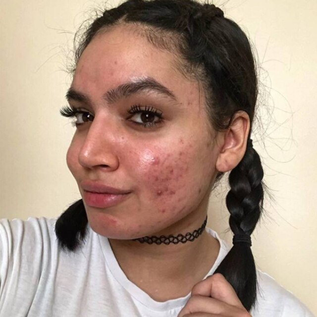 Instagram/@emeraldxbeauty A influenciadora de beleza afegã Khadeeja Khan compartilha suas experiências com a acne nas redes sociais