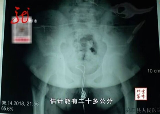 Reprodução/Heilongjiang Metropolis Channel Jovem chinês de 13 anos ficou com cabo USB preso em seu pênis.