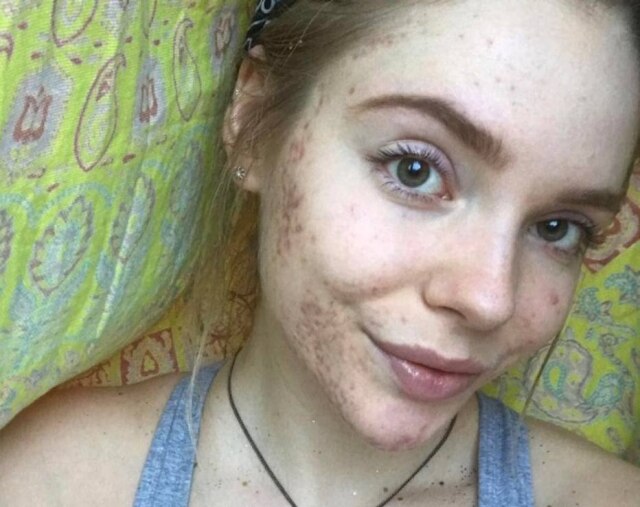 instagram.com/asprinkleofhealthandbeauty Rachel acredita que a dieta vegana reduziu suas espinhas.