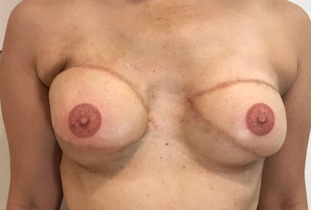 Kiko Tatoo/Divulgação Proejto Espelho, espelho meu ajuda a reconstruir gratuitamente os seios da mulher mastectomizada