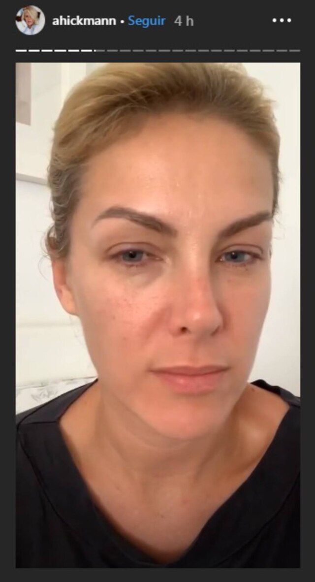 Instagram/@ahickmann Com sintomas semelhantes aos provocados pelo novo coronavírus, Ana Hickmann mostrou que está com olhos inchados e boca ressecada.